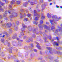 KCNAB3 Antibody - Immunohistochemical analysis of KCNAB3 staining in human breast cancer formalin fixed paraffin embedded tissue section. The section was pre-treated using heat mediated antigen retrieval with sodium citrate buffer (pH 6.0). The section was then incubated with the antibody at room temperature and detected using an HRP conjugated compact polymer system. DAB was used as the chromogen. The section was then counterstained with hematoxylin and mounted with DPX.
