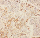 KCNB1 / Kv2.1 Antibody - Kv2.1 antibody IHC-paraffin: Human Lung Cancer Tissue.