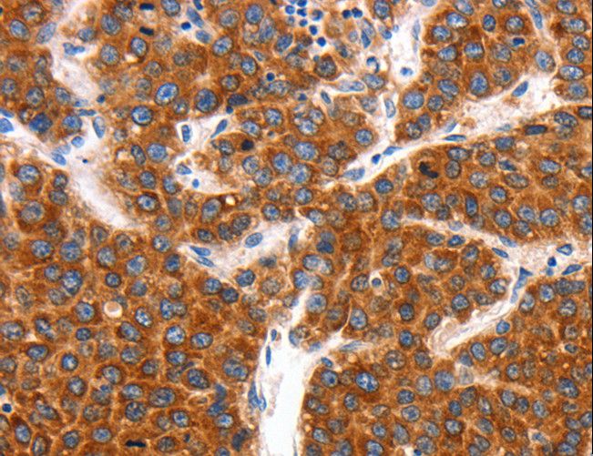 KCNC2 / Kv3.2 Antibody - Immunohistochemistry of paraffin-embedded Human colon cancer using KCNC2 Polyclonal Antibody at dilution of 1:100.
