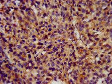 KCNC3 / Kv3.3 Antibody - Immunohistochemistry image at a dilution of 1:300 and staining in paraffin-embedded human ovarian cancer performed on a Leica BondTM system. After dewaxing and hydration, antigen retrieval was mediated by high pressure in a citrate buffer (pH 6.0) . Section was blocked with 10% normal goat serum 30min at RT. Then primary antibody (1% BSA) was incubated at 4 °C overnight. The primary is detected by a biotinylated secondary antibody and visualized using an HRP conjugated SP system.