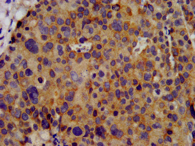 KCNC3 / Kv3.3 Antibody - Immunohistochemistry image at a dilution of 1:300 and staining in paraffin-embedded human pancreatic cancer performed on a Leica BondTM system. After dewaxing and hydration, antigen retrieval was mediated by high pressure in a citrate buffer (pH 6.0) . Section was blocked with 10% normal goat serum 30min at RT. Then primary antibody (1% BSA) was incubated at 4 °C overnight. The primary is detected by a biotinylated secondary antibody and visualized using an HRP conjugated SP system.