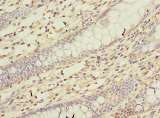 KCND2 / Kv4.2 Antibody - Immunohistochemistry of paraffin-embedded human colon cancer tissue at dilution 1:100