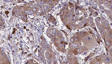KCNE1 / MinK Antibody - 1:100 staining human liver carcinoma tissues by IHC-P. The sample was formaldehyde fixed and a heat mediated antigen retrieval step in citrate buffer was performed. The sample was then blocked and incubated with the antibody for 1.5 hours at 22°C. An HRP conjugated goat anti-rabbit antibody was used as the secondary.