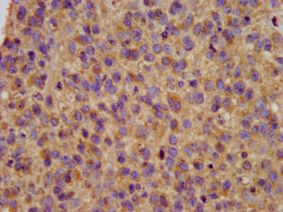 KCNE3 Antibody - Immunohistochemistry image at a dilution of 1:200 and staining in paraffin-embedded human glioma cancer performed on a Leica BondTM system. After dewaxing and hydration, antigen retrieval was mediated by high pressure in a citrate buffer (pH 6.0) . Section was blocked with 10% normal goat serum 30min at RT. Then primary antibody (1% BSA) was incubated at 4 °C overnight. The primary is detected by a biotinylated secondary antibody and visualized using an HRP conjugated SP system.