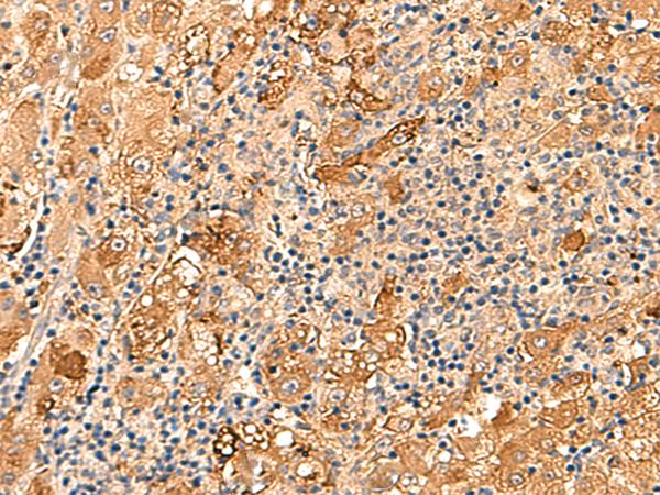 KCNE3 Antibody - Immunohistochemistry of paraffin-embedded Human liver cancer tissue  using KCNE3 Polyclonal Antibody at dilution of 1:60(×200)