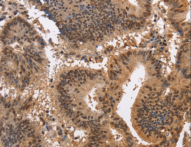 KCNG2 Antibody - Immunohistochemistry of paraffin-embedded Human colon cancer using KCNG2 Polyclonal Antibody at dilution of 1:40.