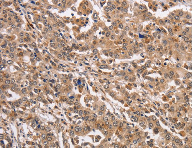 KCNG2 Antibody - Immunohistochemistry of paraffin-embedded Human liver cancer using KCNG2 Polyclonal Antibody at dilution of 1:40.