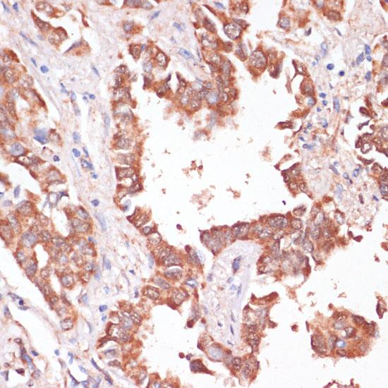 KCNH2 / HERG Antibody - Immunohistochemistry of paraffin-embedded Human lung cancer using KCNH2 Polyclonal Antibody at dilution of 1:100 (40x lens).