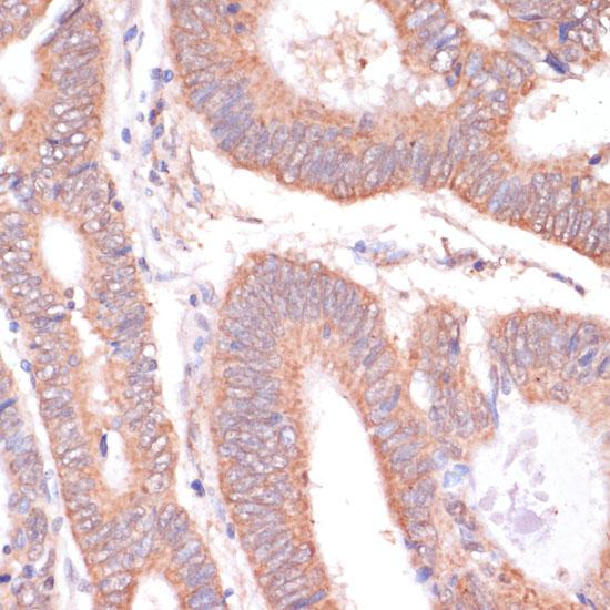 KCNH2 / HERG Antibody - Immunohistochemistry of paraffin-embedded Human colon carcinoma using KCNH2 Polyclonal Antibody at dilution of 1:100 (40x lens).