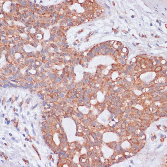 KCNH2 / HERG Antibody - Immunohistochemistry of paraffin-embedded Human breast cancer using KCNH2 Polyclonal Antibody at dilution of 1:100 (40x lens).