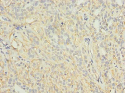 KCNH7 / ERG3 Antibody - Immunohistochemistry of paraffin-embedded human breast cancer using antibody at dilution of 1:100.