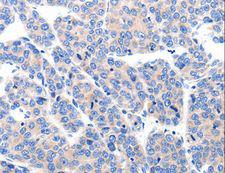 KCNH8 / ELK Antibody - Immunohistochemistry of paraffin-embedded Human liver cancer using KCNH8 Polyclonal Antibody at dilution of 1:50.