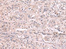 KCNIP1 / KCHIP1 Antibody - Immunohistochemistry of paraffin-embedded Human liver cancer tissue  using KCNIP1 Polyclonal Antibody at dilution of 1:60(×200)