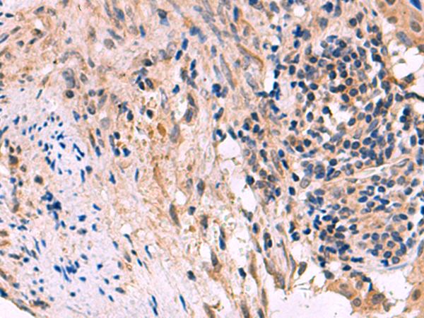 KCNIP1 / KCHIP1 Antibody - Immunohistochemistry of paraffin-embedded Human cervical cancer tissue  using KCNIP1 Polyclonal Antibody at dilution of 1:60(×200)