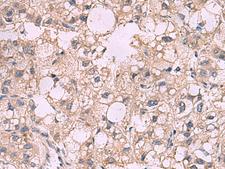 KCNIP1 / KCHIP1 Antibody - Immunohistochemistry of paraffin-embedded Human liver cancer tissue  using KCNIP1 Polyclonal Antibody at dilution of 1:40(×200)