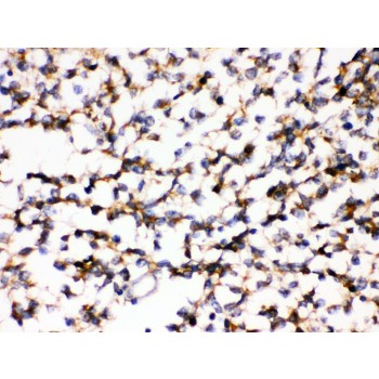 KCNIP2 / KCHIP2 Antibody - KCNIP2 antibody IHC-paraffin. IHC(P): Human Glioma Tissue.