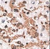 KCNIP3 / Dream / Calsenilin Antibody - Formalin-fixed and paraffin-embedded human cancer tissue reacted with the primary antibody, which was peroxidase-conjugated to the secondary antibody, followed by AEC staining. This data demonstrates the use of this antibody for immunohistochemistry; clinical relevance has not been evaluated. BC = breast carcinoma; HC = hepatocarcinoma.