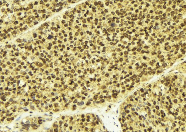 KCNIP3 / Dream / Calsenilin Antibody - 1:100 staining human breast carcinoma tissue by IHC-P. The sample was formaldehyde fixed and a heat mediated antigen retrieval step in citrate buffer was performed. The sample was then blocked and incubated with the antibody for 1.5 hours at 22°C. An HRP conjugated goat anti-rabbit antibody was used as the secondary.