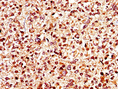 KCNJ10 / SESAME / KIR4.1 Antibody - IHC image of KCNJ10 Antibody diluted at 1:400 and staining in paraffin-embedded human glioma performed on a Leica BondTM system. After dewaxing and hydration, antigen retrieval was mediated by high pressure in a citrate buffer (pH 6.0). Section was blocked with 10% normal goat serum 30min at RT. Then primary antibody (1% BSA) was incubated at 4°C overnight. The primary is detected by a biotinylated secondary antibody and visualized using an HRP conjugated SP system.