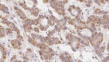 KCNJ10 / SESAME / KIR4.1 Antibody - 1:100 staining human liver carcinoma tissues by IHC-P. The sample was formaldehyde fixed and a heat mediated antigen retrieval step in citrate buffer was performed. The sample was then blocked and incubated with the antibody for 1.5 hours at 22°C. An HRP conjugated goat anti-rabbit antibody was used as the secondary.