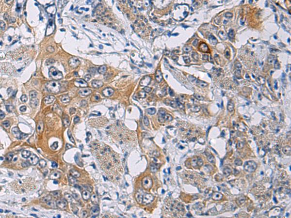 KCNJ10 / SESAME / KIR4.1 Antibody - Immunohistochemistry of paraffin-embedded Human esophagus cancer tissue  using KCNJ10 Polyclonal Antibody at dilution of 1:60(×200)