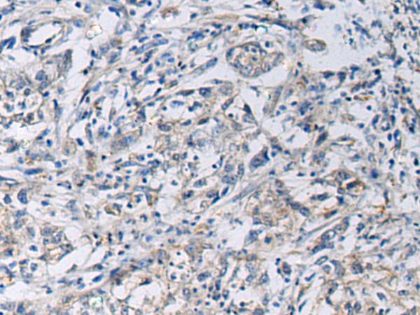 KCNJ10 / SESAME / KIR4.1 Antibody - Immunohistochemistry of paraffin-embedded Human gastric cancer tissue  using KCNJ10 Polyclonal Antibody at dilution of 1:60(×200)