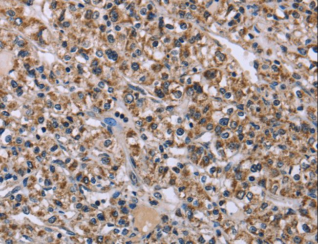 KCNJ11 / Kir6.2 Antibody - Immunohistochemistry of paraffin-embedded Human prostate cancer using KCNJ11 Polyclonal Antibody at dilution of 1:40.