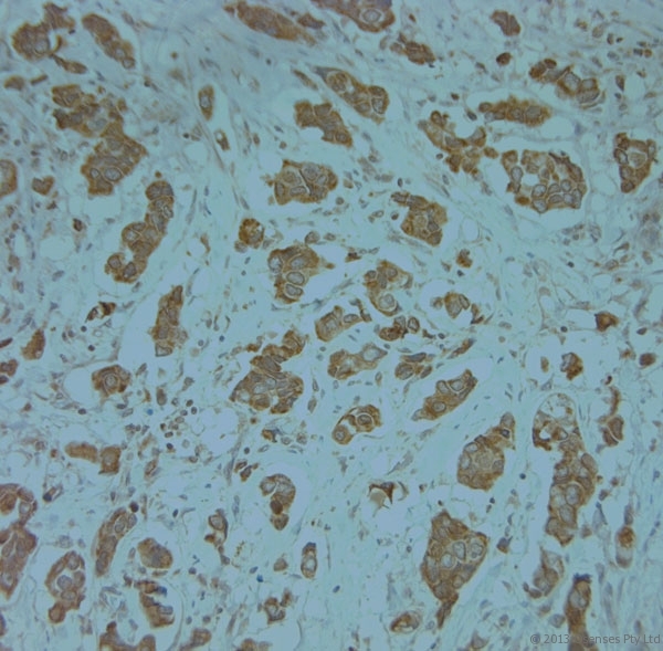 KCNJ13 / KIR7.1 Antibody - Rabbit antibody to KCNJ13 (2-50). IHC-P on paraffin sections of human breast cancer. HIER: Tris-EDTA, pH 9 for 20 min using Thermo PT Module. Blocking: 0.2% LFDM in TBST filtered through a 0.2 micron filter. Detection was done using Novolink HRP polymer from Leica following manufacturers instructions. Primary antibody: dilution 1:1000, incubated 30 min at RT (using Autostainer). Sections were counterstained with Harris Hematoxylin.