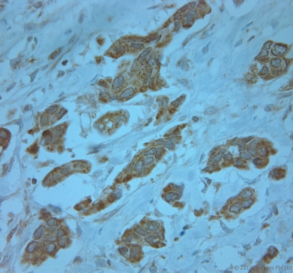 KCNJ13 / KIR7.1 Antibody - Rabbit antibody to KCNJ13 (2-50). IHC-P on paraffin sections of human breast cancer. HIER: Tris-EDTA, pH 9 for 20 min using Thermo PT Module. Blocking: 0.2% LFDM in TBST filtered through a 0.2 micron filter. Detection was done using Novolink HRP polymer from Leica following manufacturers instructions. Primary antibody: dilution 1:1000, incubated 30 min at RT (using Autostainer). Sections were counterstained with Harris Hematoxylin.