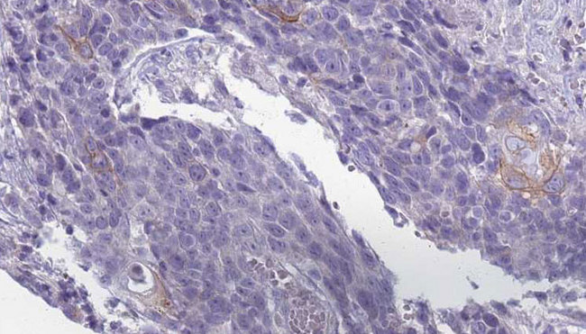 KCNJ13 / KIR7.1 Antibody - 1:100 staining human Head and neck carcinoma tissue by IHC-P. The sample was formaldehyde fixed and a heat mediated antigen retrieval step in citrate buffer was performed. The sample was then blocked and incubated with the antibody for 1.5 hours at 22°C. An HRP conjugated goat anti-rabbit antibody was used as the secondary.