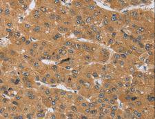 KCNJ15 / KIR4.2 Antibody - Immunohistochemistry of paraffin-embedded Human cervical cancer using KCNJ15 Polyclonal Antibody at dilution of 1:40.