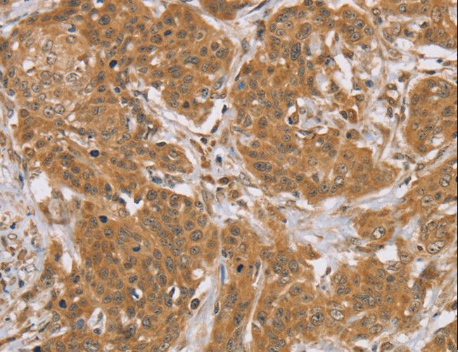 KCNJ15 / KIR4.2 Antibody - Immunohistochemistry of paraffin-embedded Human cervical cancer using KCNJ15 Polyclonal Antibody at dilution of 1:40.