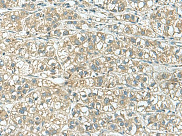 KCNJ2 / Kir2.1 Antibody - Immunohistochemistry of paraffin-embedded Human liver cancer tissue  using KCNJ2 Polyclonal Antibody at dilution of 1:25(×200)