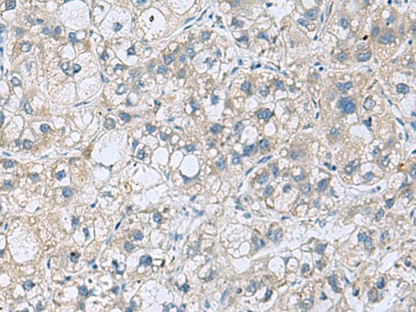 KCNJ2 / Kir2.1 Antibody - Immunohistochemistry of paraffin-embedded Human liver cancer tissue  using KCNJ2 Polyclonal Antibody at dilution of 1:35(×200)