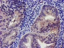 KCNJ3 / GIRK1 Antibody - IHC of paraffin-embedded Adenocarcinoma of Human endometrium tissue using anti-KCNJ3 mouse monoclonal antibody.