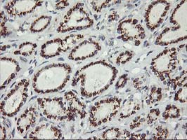 KCNJ3 / GIRK1 Antibody - IHC of paraffin-embedded Carcinoma of Human thyroid tissue using anti-KCNJ3 mouse monoclonal antibody.