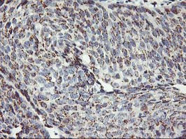 KCNJ3 / GIRK1 Antibody - IHC of paraffin-embedded Carcinoma of Human bladder tissue using anti-KCNJ3 mouse monoclonal antibody.