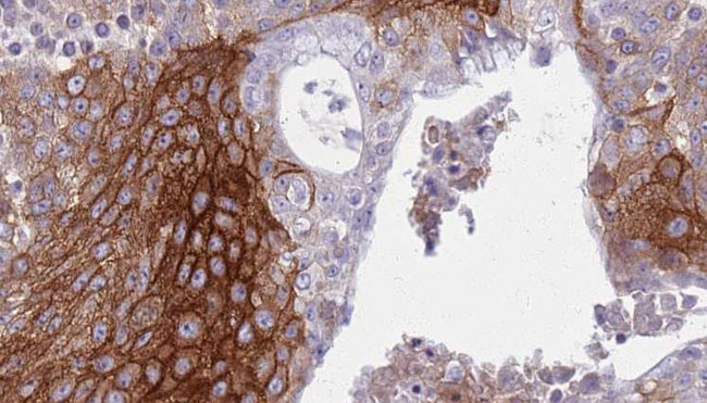 KCNJ3 / GIRK1 Antibody - 1:100 staining human urothelial carcinoma tissue by IHC-P. The sample was formaldehyde fixed and a heat mediated antigen retrieval step in citrate buffer was performed. The sample was then blocked and incubated with the antibody for 1.5 hours at 22°C. An HRP conjugated goat anti-rabbit antibody was used as the secondary.