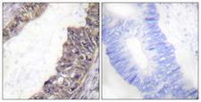 KCNJ3 / GIRK1 Antibody - Immunohistochemistry analysis of paraffin-embedded human colon carcinoma, using GIRK1/KIR3.1/KCNJ3 (Phospho-Ser185) Antibody. The picture on the right is blocked with the phospho peptide.