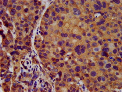 KCNJ8 / Kir6.1 Antibody - Immunohistochemistry image at a dilution of 1:500 and staining in paraffin-embedded human pancreatic cancer performed on a Leica BondTM system. After dewaxing and hydration, antigen retrieval was mediated by high pressure in a citrate buffer (pH 6.0) . Section was blocked with 10% normal goat serum 30min at RT. Then primary antibody (1% BSA) was incubated at 4 °C overnight. The primary is detected by a biotinylated secondary antibody and visualized using an HRP conjugated SP system.