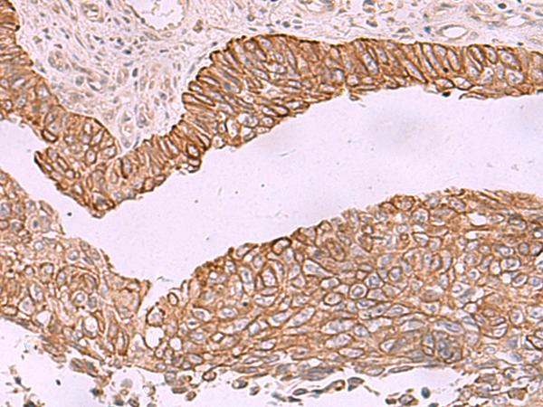 KCNK12 Antibody - Immunohistochemistry of paraffin-embedded Human lung cancer tissue  using KCNK12 Polyclonal Antibody at dilution of 1:60(×200)