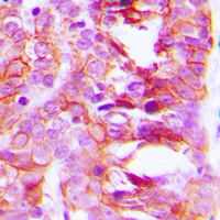 KCNK15 Antibody - Immunohistochemical analysis of KCNK15 staining in human breast cancer formalin fixed paraffin embedded tissue section. The section was pre-treated using heat mediated antigen retrieval with sodium citrate buffer (pH 6.0). The section was then incubated with the antibody at room temperature and detected using an HRP conjugated compact polymer system. DAB was used as the chromogen. The section was then counterstained with hematoxylin and mounted with DPX.