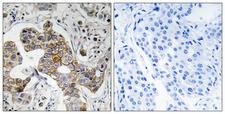 KCNK15 Antibody - Peptide - + Immunohistochemistry analysis of paraffin-embedded human breast carcinoma tissue using KCNK15 antibody.