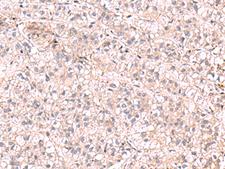 KCNK18 / TRESK Antibody - Immunohistochemistry of paraffin-embedded Human liver cancer tissue  using KCNK18 Polyclonal Antibody at dilution of 1:75(×200)