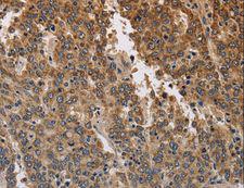 KCNK9 / TASK3 Antibody - Immunohistochemistry of paraffin-embedded Human liver cancer using KCNK9 Polyclonal Antibody at dilution of 1:40.