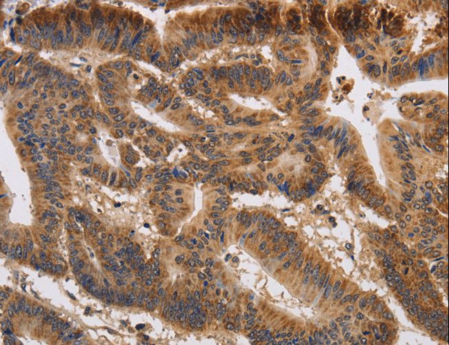 KCNK9 / TASK3 Antibody - Immunohistochemistry of paraffin-embedded Human colon cancer using KCNK9 Polyclonal Antibody at dilution of 1:40.