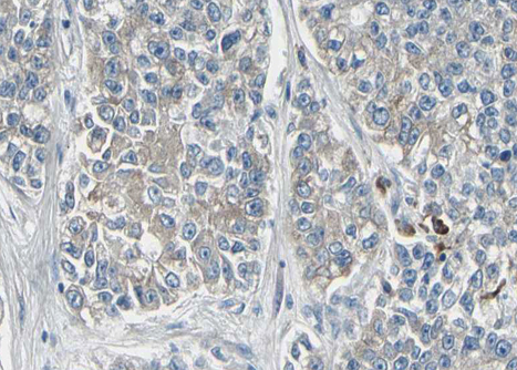 KCNMA1 / BK Antibody - 1:100 staining human lung carcinoma tissue by IHC-P. The tissue was formaldehyde fixed and a heat mediated antigen retrieval step in citrate buffer was performed. The tissue was then blocked and incubated with the antibody for 1.5 hours at 22°C. An HRP conjugated goat anti-rabbit antibody was used as the secondary.