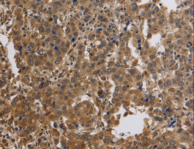 KCNMB4 Antibody - Immunohistochemistry of paraffin-embedded Human liver cancer using KCNMB4 Polyclonal Antibody at dilution of 1:40.