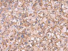 KCNN1 Antibody - Immunohistochemistry of paraffin-embedded Human liver cancer tissue  using KCNN1 Polyclonal Antibody at dilution of 1:55(×200)
