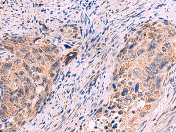 KCNN1 Antibody - Immunohistochemistry of paraffin-embedded Human cervical cancer tissue  using KCNN1 Polyclonal Antibody at dilution of 1:55(×200)